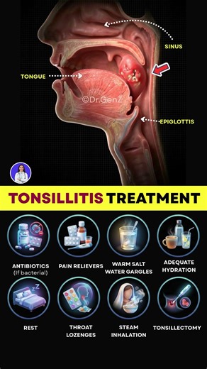 Tonsillitis Treatment Explained - Home Remedies, Medicines & Surgery