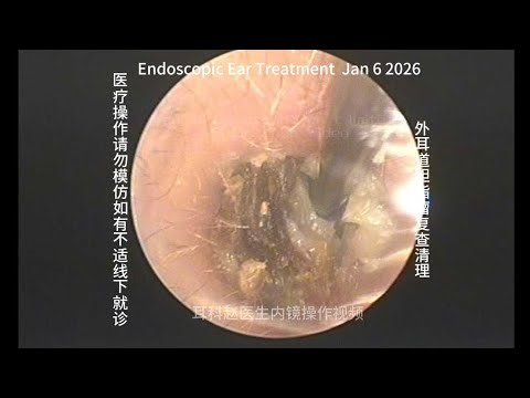 Follow-up and Debridement of External Auditory Canal Cholesteatoma 20260106