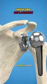 Shoulder Replacement Surgery Explained 3D Animation — Anatomic vs Reverse Total #shortvideo