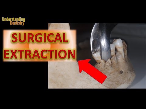 When to do Root Sectioning and Surgical Extraction with Open Flap for Osteotomy?