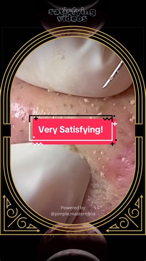 Blackheads removal at SPA Skincare Satisfying Video #blackheadsremoval #blackhead #acnetreatment #skincare #satisfying