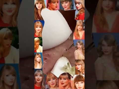 Blackheads Removal #338 | Acne Treatment and Very Satisfying Satisfying Pimple pop #blackheads