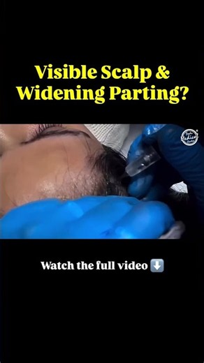 Scalp Micropigmentation for Hair Thinning: How Does SMP Work? #scalpmicropigmentation #scalpcare