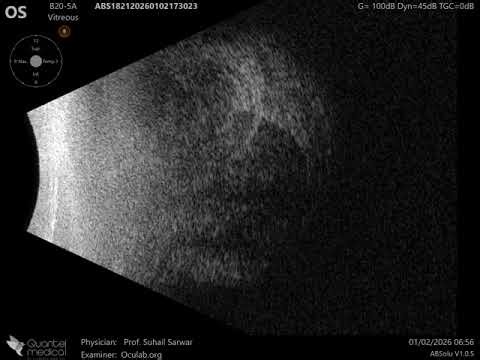 20 MHz Annular Ophthalmic Ultrasound ABSolu, Pseudotumor lacrimal gland , 36895