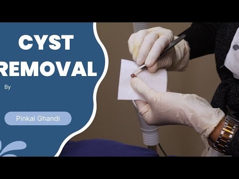 Cyst Removal Procedure | Safe & Professional Treatment Explained (Watch Before You Book)