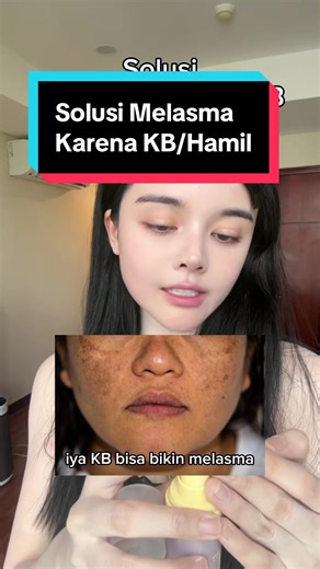 Melasma disebabkan hormon tapi tetap aja diperparah oleh panas dan UV. Pencegahan sebelum melebar adalah terbaik. Boleh coba serum Lishui ini, paginya pake sunscreen mineral/tinted malamnya pake retinoid. Boleh oot #skincare #flek #melasma #darkspot #lentigo