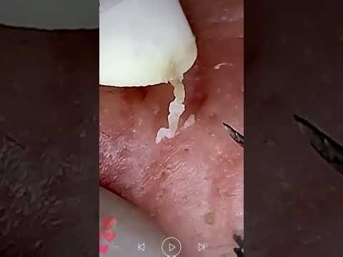 Skincare | Blackheads Removal #806 #tweezers skincare #blackheads blackheads