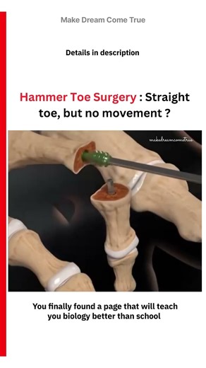 🦴 Hammer Toe Surgery : 👣 Straight toe, but no movement ⚙️| MDCT