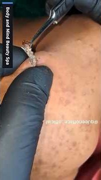 See what she pulls out!👀 #blackheads #pimplepopping #satisfying #shortsfeed #viralvideos