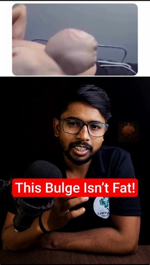 Abdominal hernia explained | Causes, signs & why it shouldn’t be ignored