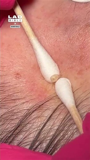 Laser cyst pop is so satisfying 😲 (🎥: IG/ skinbydrazi)