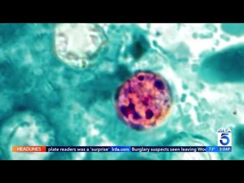 Cyclospora Outbreak: Symptoms, Prevention & Treatment