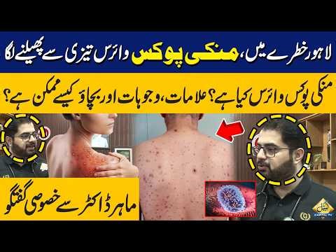 Monkeypox Virus Spreads Rapidly | Symptoms, Causes and How to Stay Safe? | Capital TV