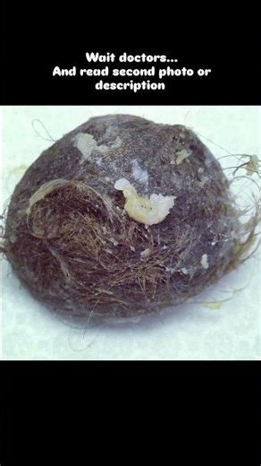 hairball removed from a teratoma/dermoid ovary cyst #shortvideo #viralvideo