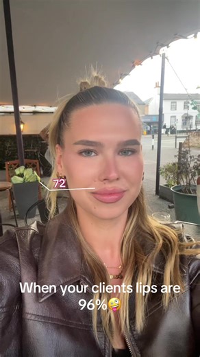 When your clients lips SLAY🤪👄💋 #lipfiller #aesthetics #business #bestfriends