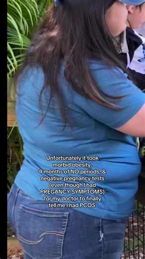 I look back and I see so many PCOS symptoms that aren’t just irregular periods and excess facial hair. I see “PCOS belly”, where I had excess weight in my abdomen. I didn’t only feel pregnant, I remember thinking I often looked pregnant. But I wasn’t and I was crushed. So often was hope taken away. The rapid weight gain would come out of nowhere and make me think I was pregnant again from the symptoms, and I wasn’t. I had “PCOS moon face”, swelling in my cheeks and rounded appearance in my face.