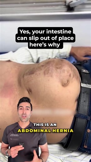 Ever heard of a hernia? It’s most commonly caused by intestines pushing through a weak spot in your abdominal wall muscles. It might look like a bulge, and while some are harmless, others can turn serious if ignored. #medical #hernia #abdominalhernia vc: @drmarcelo_duarte