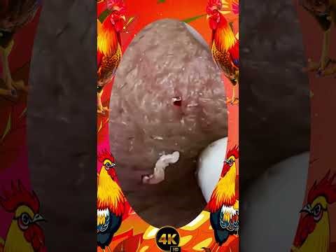 Blackheads Removal #358 | Acne Treatment and Very Satisfying Satisfying Pimple pop #blackheads