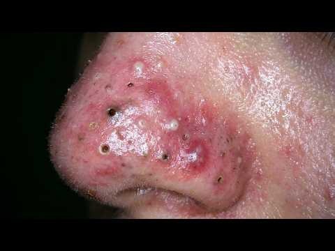 Loan Nguyen Acne Treatment 51zz