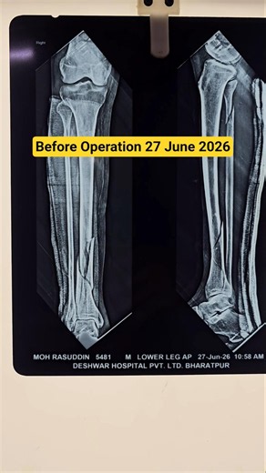 Tibia bone fracture After Surgery in Deshwar Hospital by Dr. Gaurav Deshwar