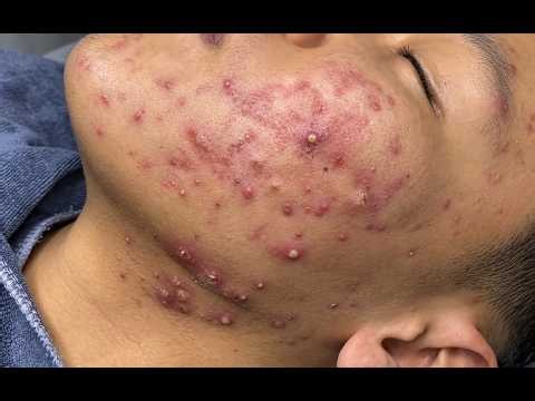 NEW 2026 🤯 Massive Acne Removal | Satisfying Pimple Extraction#10355