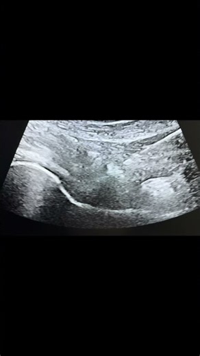 Ultrasound Guided Hip Joint Injection