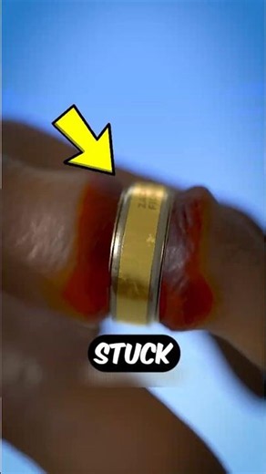 Ring Stuck on Your Finger Don’t Pull… Do THIS 😳