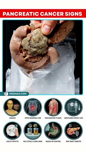 Pancreatic Cancer Signs You Should Never Ignore | Pancreatic Cancer Warning Signs