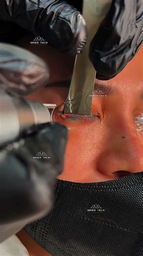 #LaserTattooRemoval #PicoLaser #MicrobladingRemoval #EyebrowTattooRemoval #PermanentMakeup #PMU#fyp