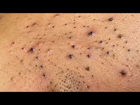 Extreme Blackhead Removal #1 | Satisfying Pimple Pop & Deep Skin Cleaning #Blackheads