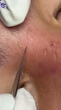 So Satisfying Pimples Removal & Popping I Skin Care Short 105