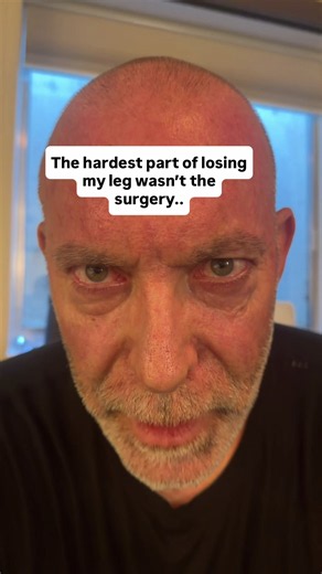 The hardest part of losing my leg was not having the surgery It’s been the journey of being able to see myself as whole, even without my left leg.