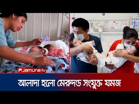 পেরুতে অস্ত্রোপচার করে মেরুদণ্ড জোড়া যমজকে আলাদা করলেন চিকিৎসকরা | Peru Twin Operation | Jamuna TV