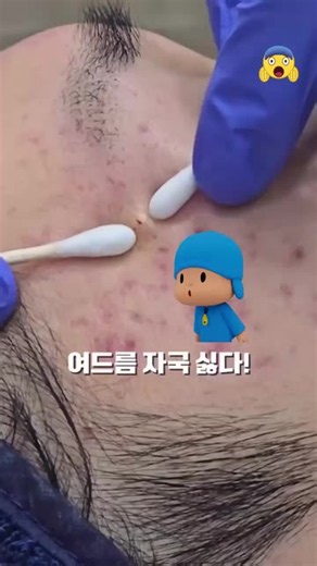 Pimple Extraction ASMR: Watch These Clogged Pores Explode!