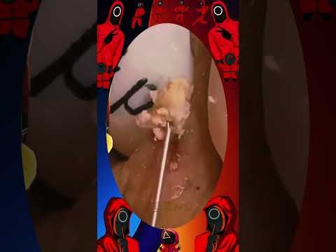 Blackheads Removal #335 | Acne Treatment and Very Satisfying Satisfying Pimple pop #blackheads