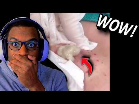 Satisfying Pimple Pop Reaction | You Won't Believe This!