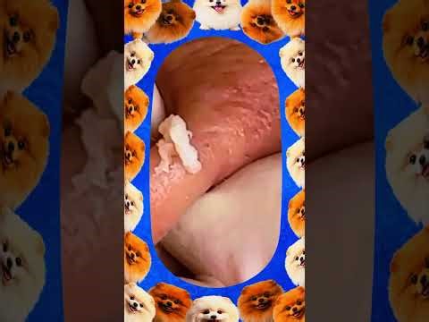 Blackheads Removal | Acne Treatment and Very Satisfying Satisfying Pimple pop #blackheads
