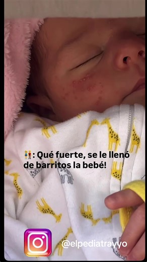 ✨ Acné neonatal (también llamado “florecimiento”) ✨ No todos lo saben, pero muchos bebés presentan acné neonatal, y es completamente normal y benigno. 🌸 ¿Qué es el acné neonatal? Son pequeños granitos rojizos o blanquecinos que aparecen con mayor frecuencia en: \t•\tMejillas \t•\tNariz \t•\tFrente \t•\tA veces mentón 📅 ¿Cuándo aparece? Suele salir entre la segunda y cuarta semana de vida. Puede durar desde unas semanas hasta varios meses, y desaparece solo. 🧠 ¿Por qué ocurre? Se relaciona con