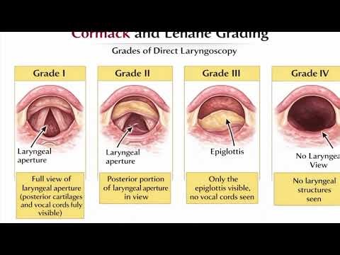 CORMACK&LEHANE GRADING (DIRECT LARYNGOSCOPY &MLS )