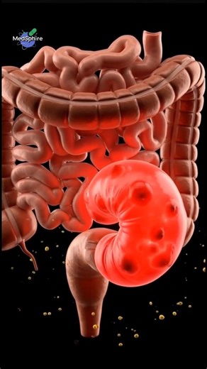 Appendicitis | Appendix sign and symptoms #anatomy #appendicitis #meded #shorts