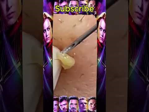 Blackheads Removal #271 | Acne Treatment and Very Satisfying Satisfying Pimple pop #blackheads