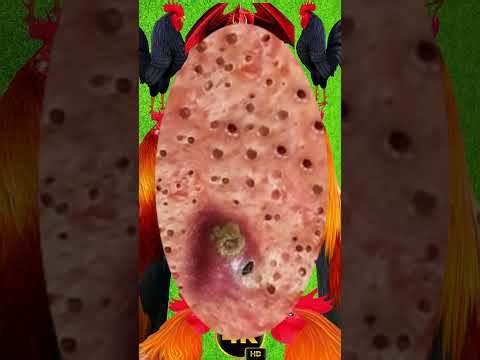 Blackheads Removal #190 | Acne Treatment and Very Satisfying Satisfying Pimple pop #blackheads