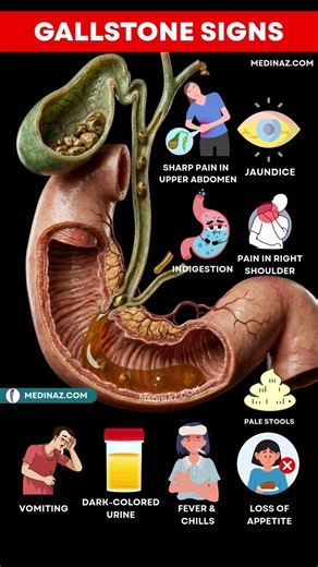 10 Early Signs of Gallstones You Should Never Ignore | Gallbladder Stone Signs