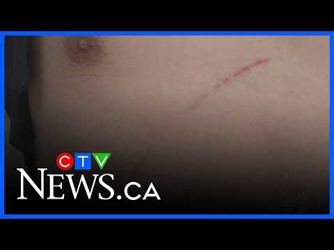 Couple speaks out after brutal attack in Vancouver