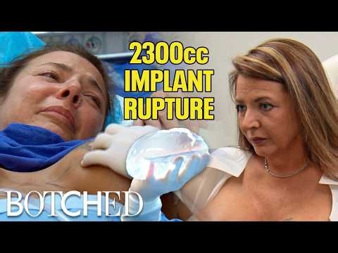 Dr. Dubrow RUPTURES Ilana's 2300cc Implants On Purpose?! (Before & After) | Botched | E!