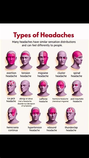 Headache Types Explained in 60 Seconds #humanbody #radiology #science #anatomy #shorts #shortvideo
