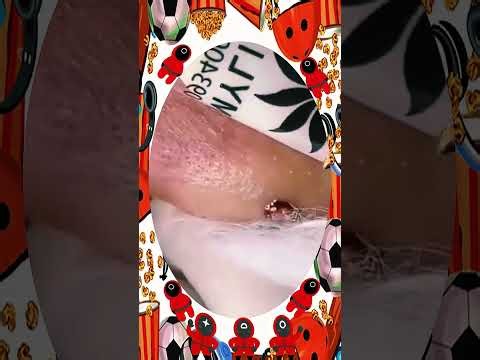 Blackheads Removal #469 | Acne Treatment and Very Satisfying Satisfying Pimple pop #blackheads