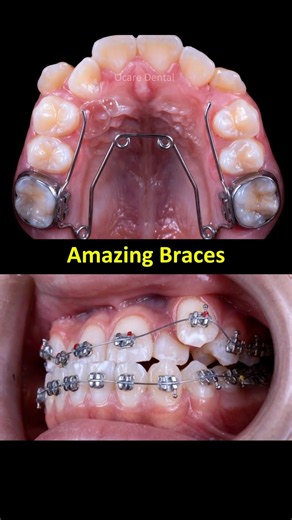 Amazing orthodontic result: Combining a Quad Helix and braces for crowding and an underbite. #braces