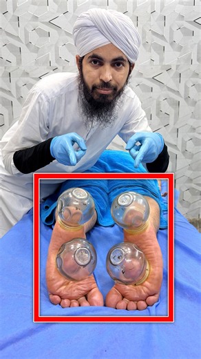 Foot Pain, Stiffness & Tired Feet Relief | Fire Cupping & Therapeutic Foot Therapy | Dr Usman Faiz
