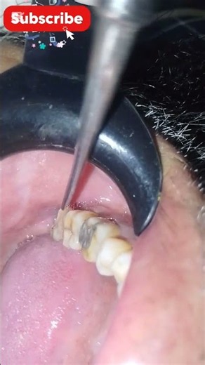Professional wisdom tooth extraction